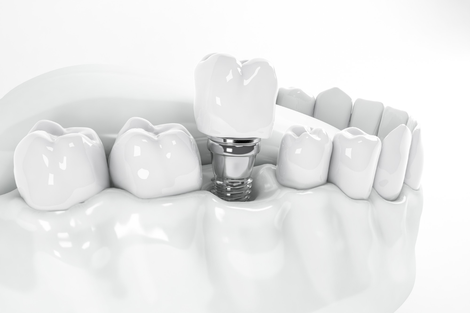 por qué ponerse implantes dentales